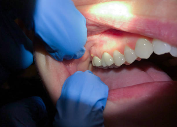 Best Emergency Dental Care for Broken or Chipped Teeth in Crescent, OK